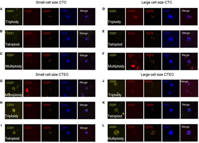 Aneuploid subtypes of circulating tumor cells and circulating tumor-derived endothelial cells predict the overall survival of advanced lung cancer